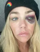 Aaron Phypers’ pal claims Denise Richards’ black eye was result of a drunken fall, not abuse